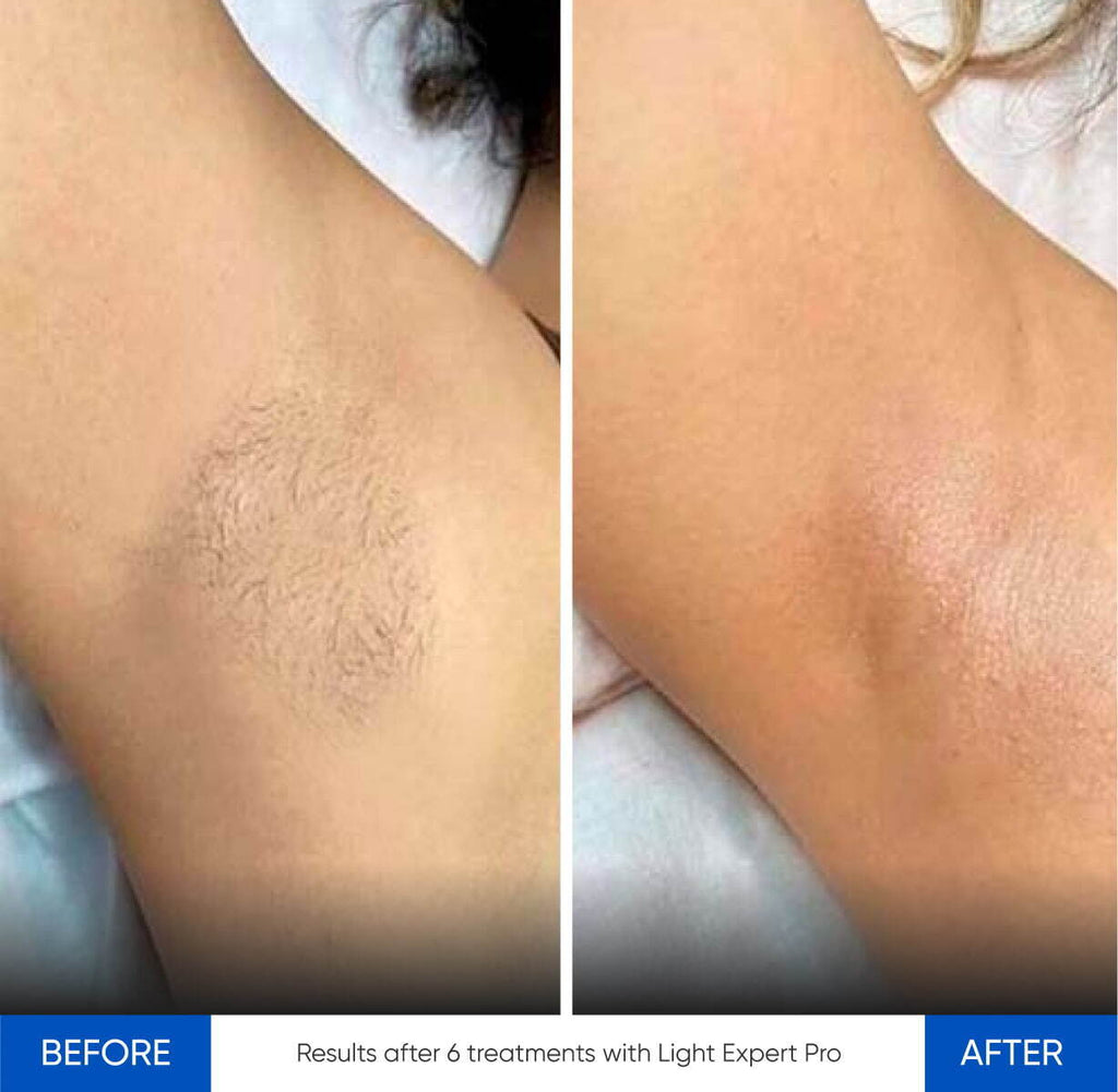 Before and after IPL treatment results Zemits Light Expert Pro