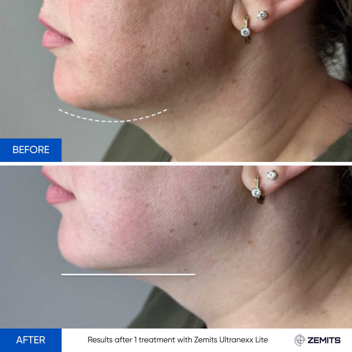 Before After Slide 2