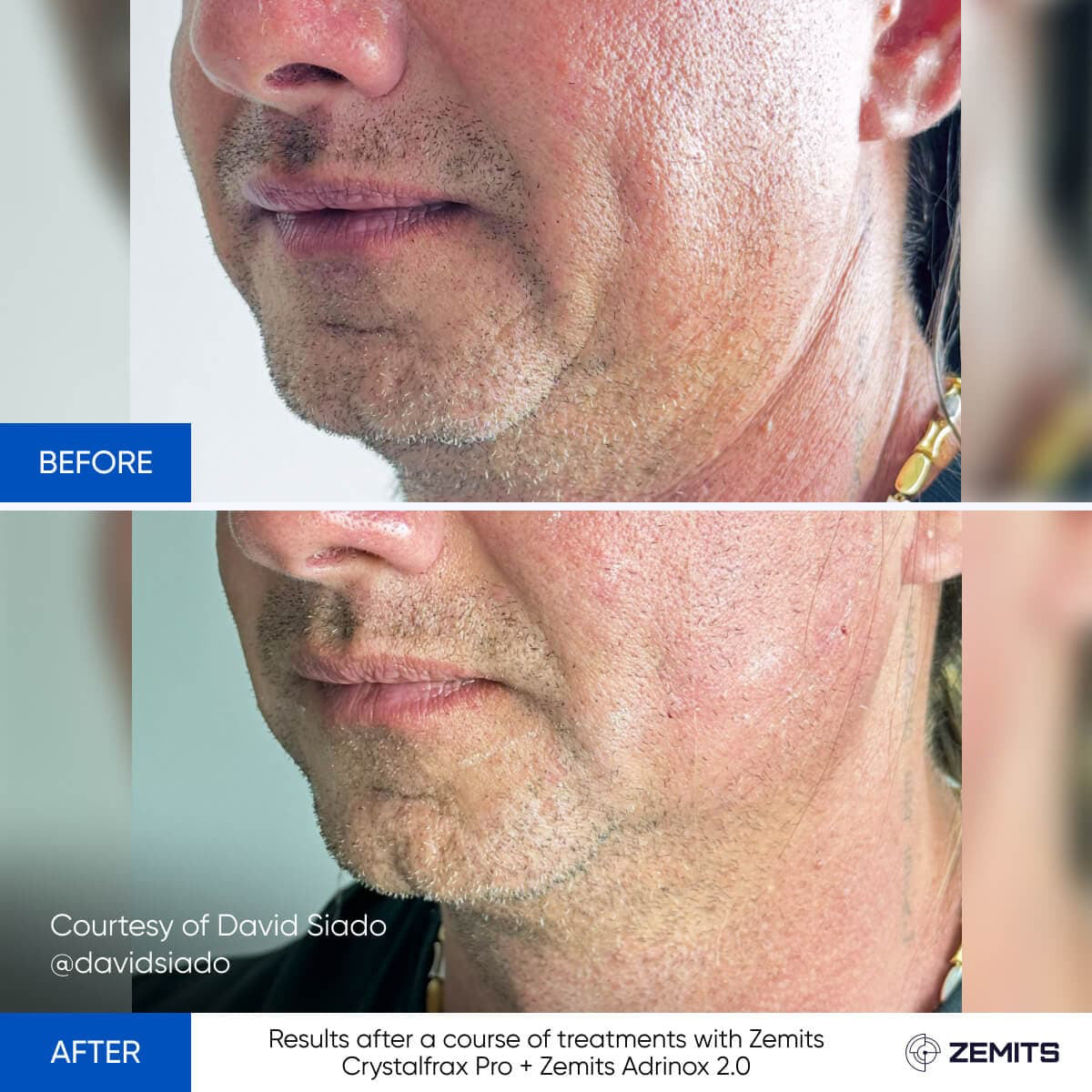 Before After Slide 1