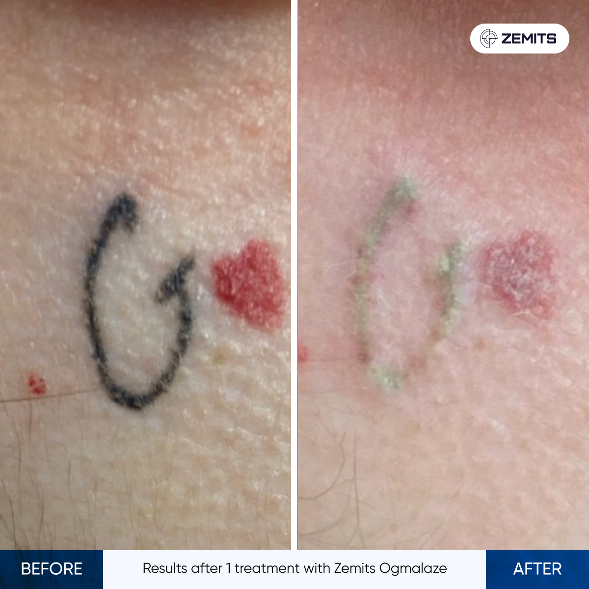 Before and after tattoo removal results Zemits OgmaLaze