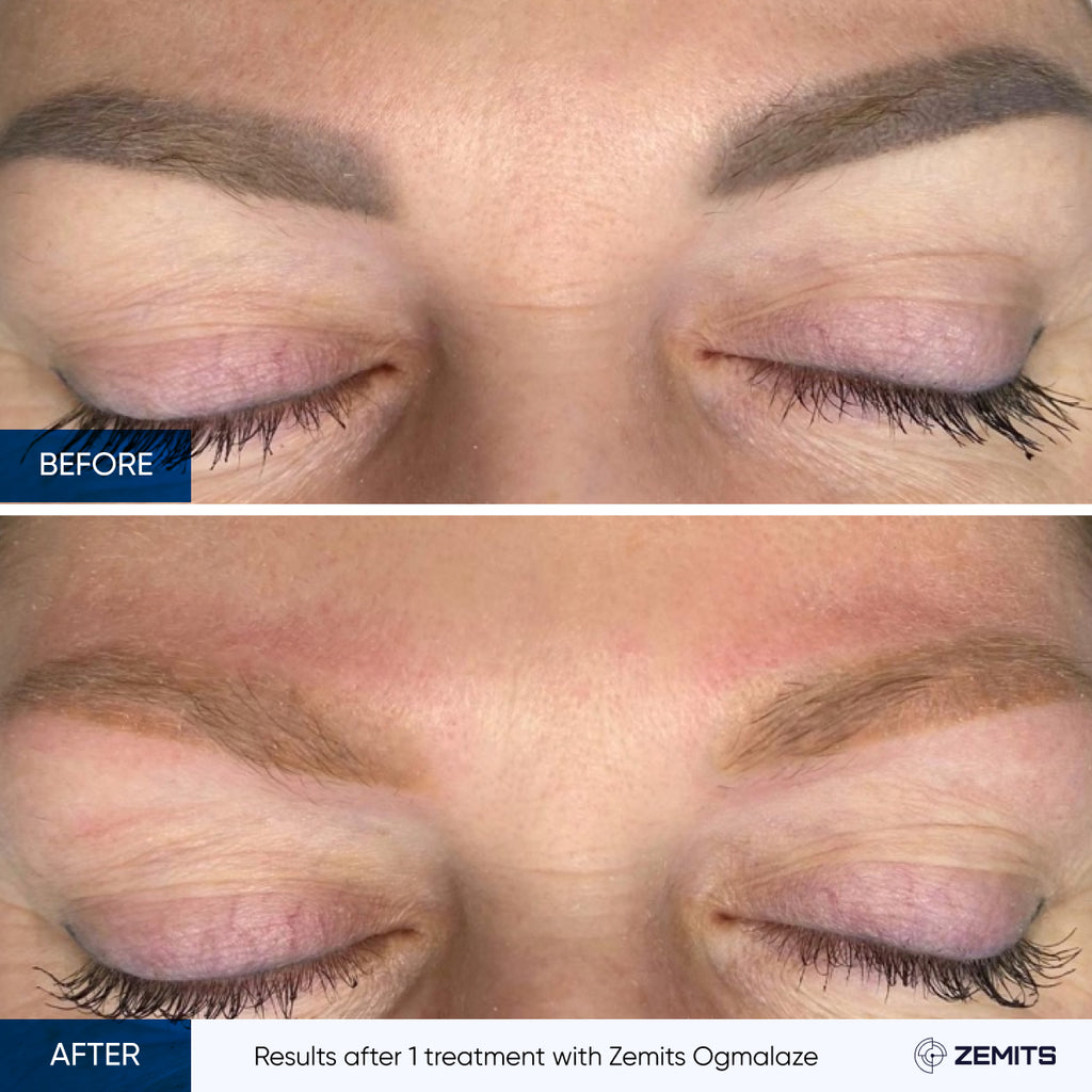 Before and after tattoo removal results Zemits OgmaLaze