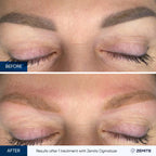Before and after tattoo removal results Zemits OgmaLaze