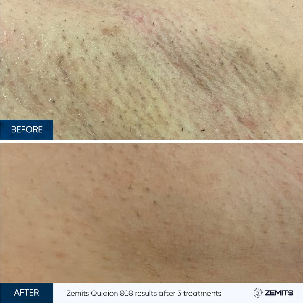 Before and after laser hair removal results Zemits Quidion
