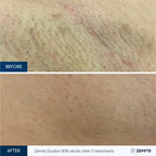 Before and after laser hair removal results Zemits Quidion