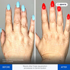 Before and after laser hair removal results Zemits Quidion