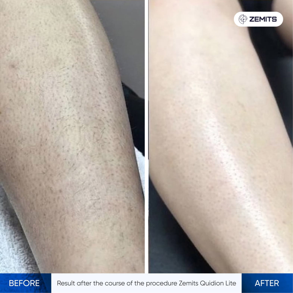 Before After Slide 1