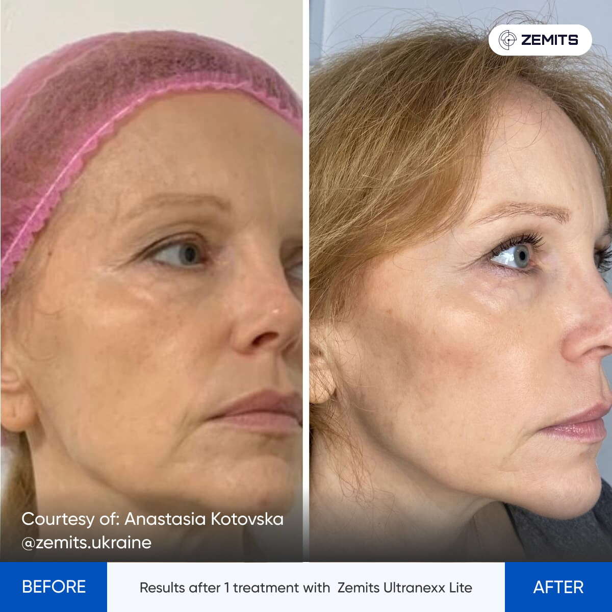 Before After Slide 2