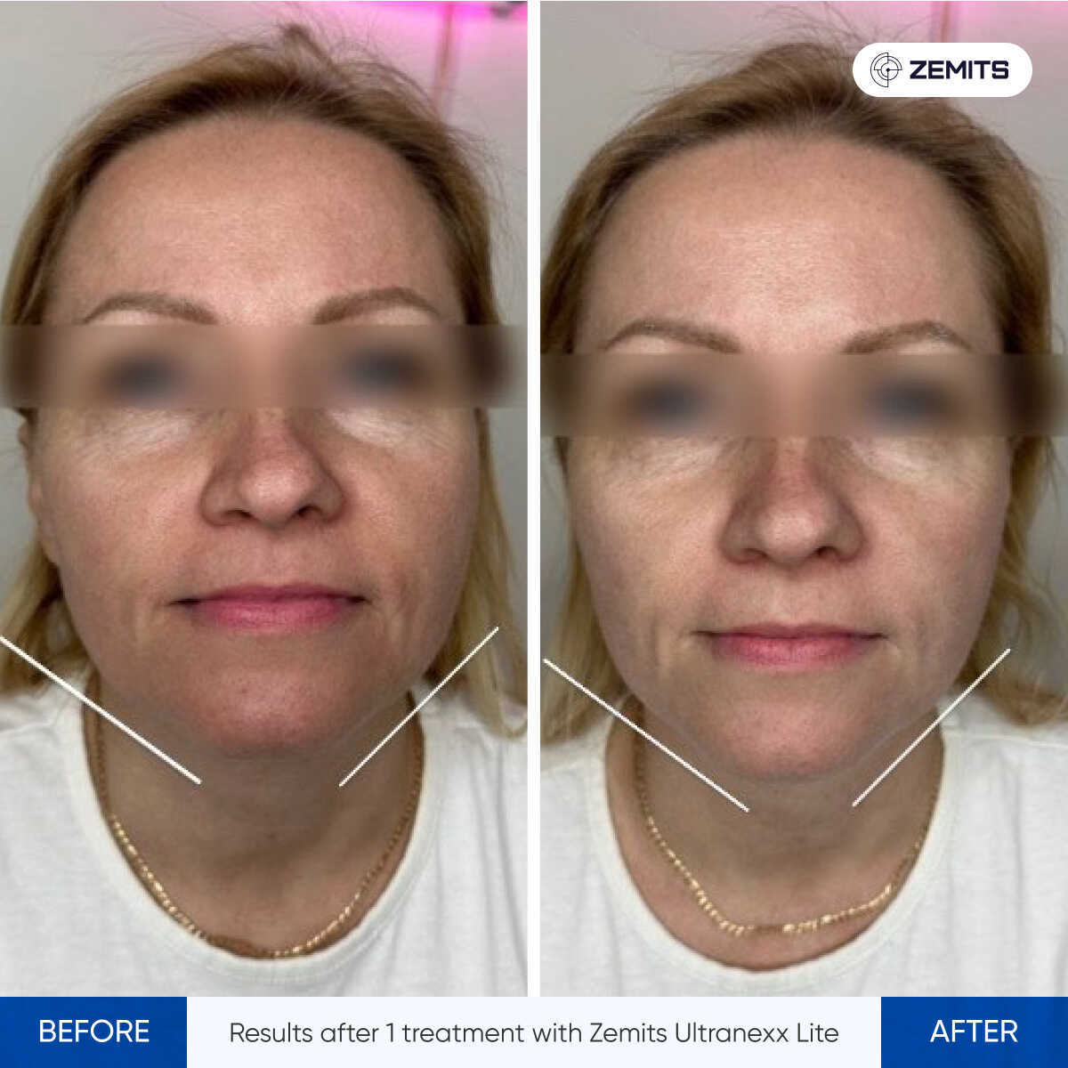 Before After Slide 3